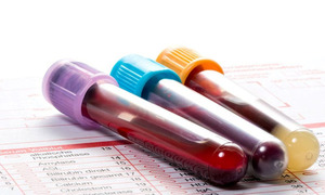 Científicos hallan en las grasas de la sangre pistas para diagnosticar TDAH y adicciones - OviedoPress