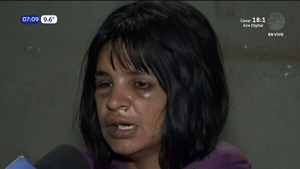 Mujer denuncia brutal agresión por parte de su ex pareja en San Lorenzo