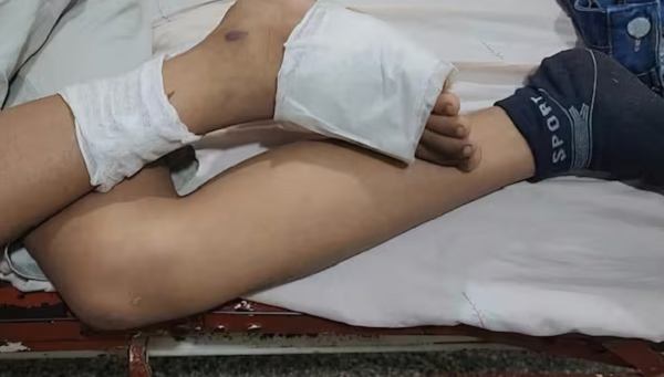 Niño sufrió quemaduras al pisar un cable suelto de la ANDE - Noticiero Paraguay