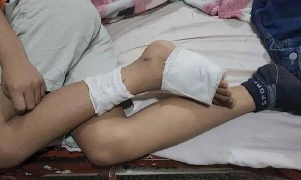 Niño de 11 años sobrevive a descarga eléctrica tras pisar cable suelto de la ANDE en Concepción – Prensa 5