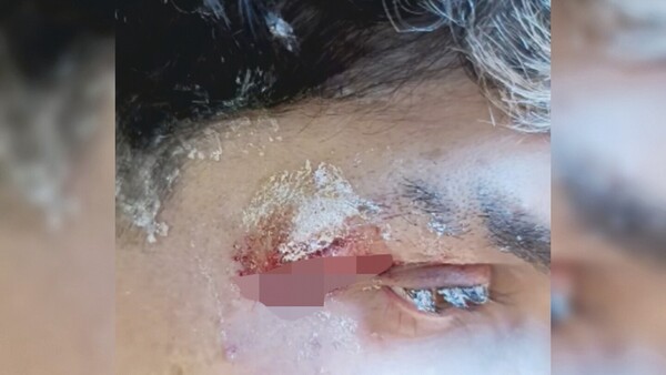 Usaron “la gotita” en su herida y le estalló en la cara: casi queda ciego