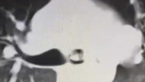 Extraen parte de una prótesis dental del pulmón de un paciente en el Ineram