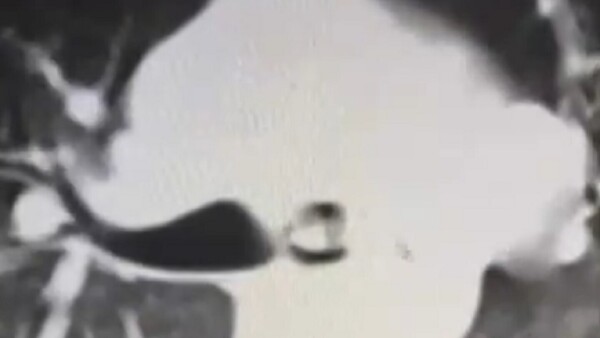 Extraen parte de una prótesis dental del pulmón de un paciente en el Ineram