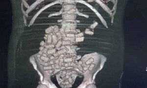 Descubren capsulas en estómago de un hombre que se desvaneció en el Puente de la Amistad – Prensa 5