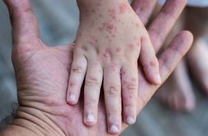 Preocupan los brotes de sarampión en países vecinos