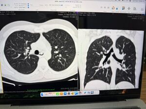 IPS INGAVI lleva a cabo una pionera extracción de un tumor
