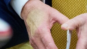 Presidente de EEUU, diagnosticado con insuficiencia venosa