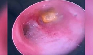 Grano de maíz quedó en la tráquea de un niño: lo operaron de urgencia – Prensa 5