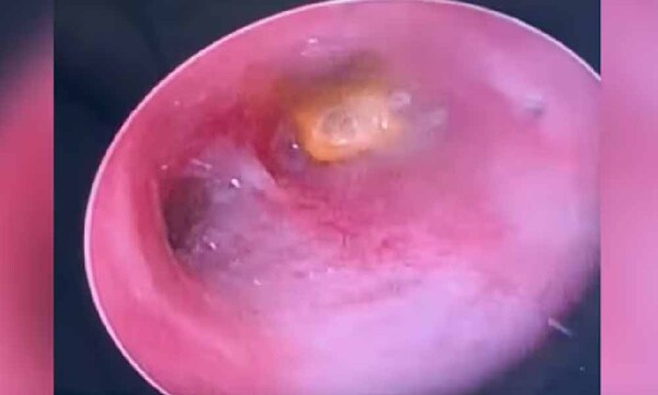 Grano de maíz quedó en la tráquea de un niño: lo operaron de urgencia – Prensa 5