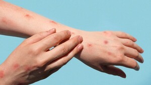 Sarampión: el virus reaparece y Salud llama a completar vacunas