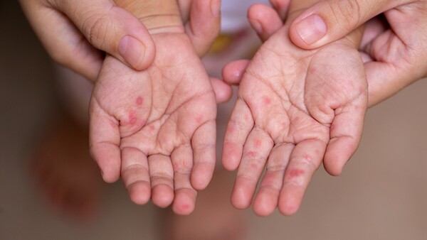 ¡Vuelven todas las karachas! Detectan caso de sarampión en un niño de San Pedro