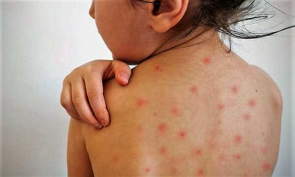 San Pedro: Activan cerco epidemiológico por caso confirmado de sarampión - ADN Digital