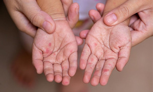 Niño con sarampión se habría contagiado de parientes llegados de Bolivia - OviedoPress