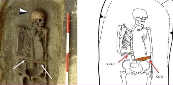 Impactante hallazgo en Italia: un hombre medieval reemplazó su mano con un cuchillo - Ciencia - ABC Color