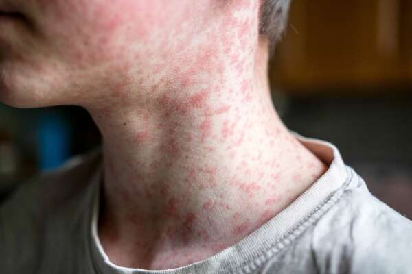 Alerta epidemiológica ante brote de sarampión, declara el Ministerio de Salud - Nacionales - ABC Color