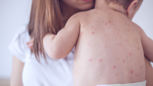 Alerta epidemiológica ante brote de sarampión en casos importados • PARAGUAY TV