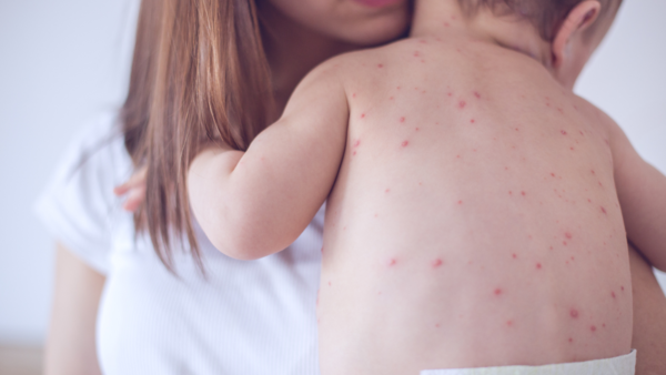 Alerta epidemiológica ante brote de sarampión en casos importados • PARAGUAY TV