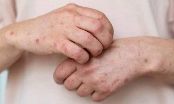 Salud emite alerta epidemiológica ante nuevos brotes de sarampión  - trece