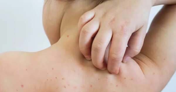 La Nación / Ante casos de sarampión hay alerta epidemiológica