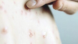 Advierten sobre imputación a padres de niños sin vacuna