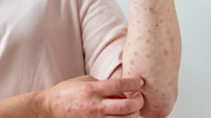 ¡Alerta a los brotes! El sarampión en adultos mayores “puede ser potencialmente mortal”
