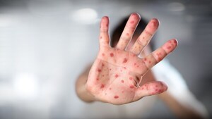 Confirman siete casos positivos de sarampión en los últimos días