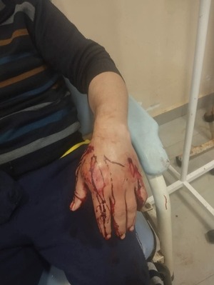 Popular / Asaltantes balearon a karai en la mano para robarle la moto