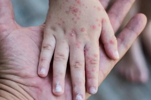 Alerta sanitaria en San Pedro: confirman 16 casos de sarampión   | Unicanal