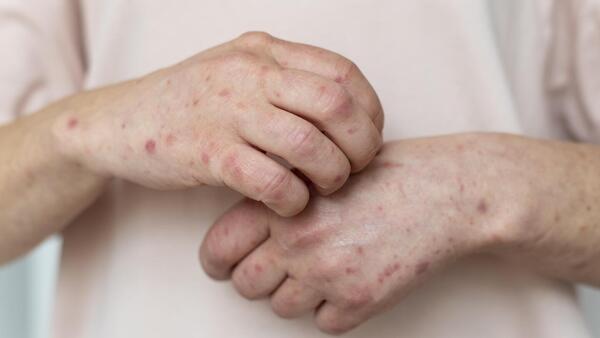 Salud confirma 9 casos más de sarampión e impulsa campaña de vacunación en San Pedro