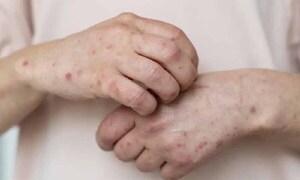 Salud confirma 9 casos más de sarampión e impulsa campaña de vacunación en San Pedro – Prensa 5