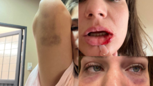 Brasileña espera justicia tras denunciar a futbolista paraguayo por múltiples agresiones