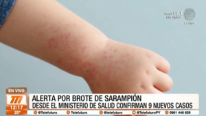 Alerta por Sarampión: confirmaron nueve casos más