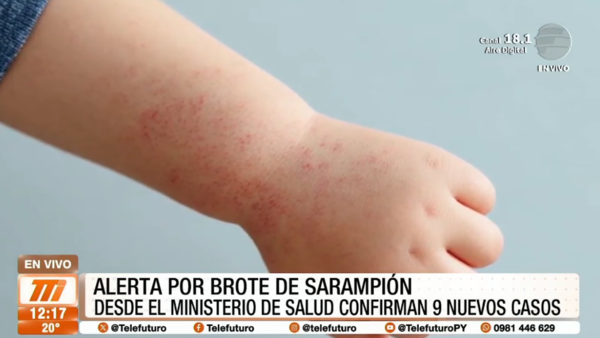 Alerta por Sarampión: confirmaron nueve casos más