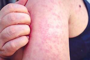 Sarampión: infectólogo lamenta que población de riesgo haya dejado de vacunarse desde la pandemia  - Nacionales - ABC Color