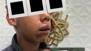 Bullying al extremo: Adolescente autista fue desfigurado a golpes por sus compañeros de cole