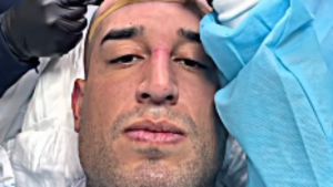 “Ganando cabello, bro”: el pesoca Macaccino se hizo trasplante capilar tras quedar pelado