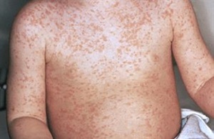Confirman que ya son 24 las personas afectadas por el virus del sarampión en San Pedro
