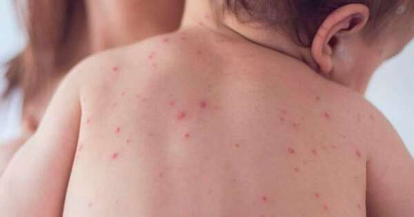 La Nación / El virus del sarampión puede provocar meningitis, encefalitis y neumonía, alertan