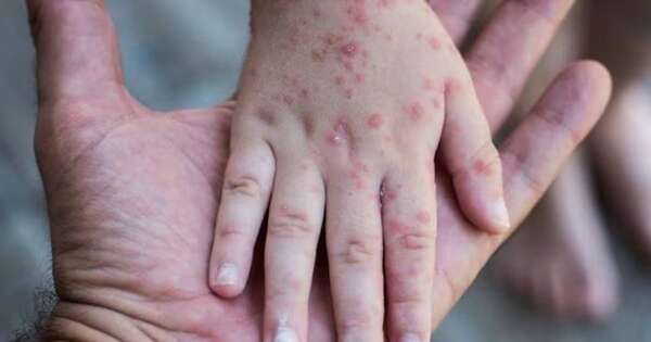 La Nación / Al año, 98.000 niños tienen que ser vacunados contra el sarampión