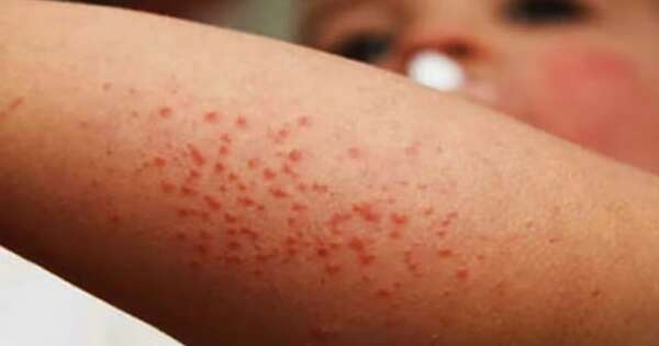 La Nación / Atribuyen a la corriente antivacuna la reaparición del sarampión en Paraguay