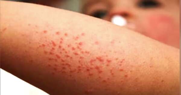 La Nación / Atribuyen a corriente antivacuna reaparición del sarampión en el país