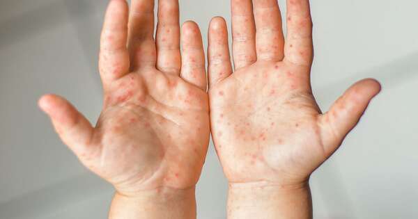 Diario HOY | Salud confirma tres nuevos casos de sarampión, total asciende a 38