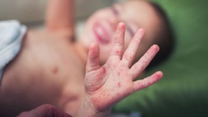 PARAGUAY DETECTA TRES NUEVOS CASOS DE SARAMPIÓN