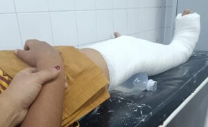Alumno de 10 años sufrió fractura al ser agredido por su compañero