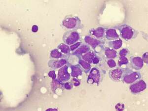 ¡Esperanza contra el cáncer infantil! Nuevo enfoque en el tratamiento del sarcoma de Ewing - Ciencia - ABC Color