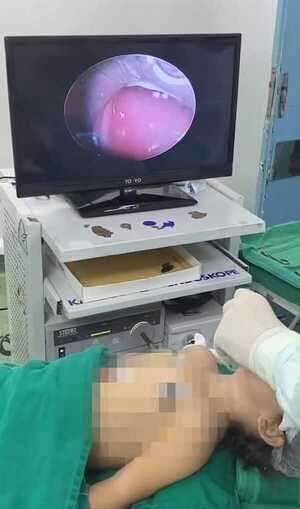 Popular / Niña de 2 años está grave y en terapia intensiva por culpa de una maní