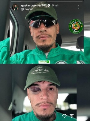 Popular / ¡Ndi bárbaro! El pelotero guaraní Gustavo Gómez mostró como le quedó el ojo anga