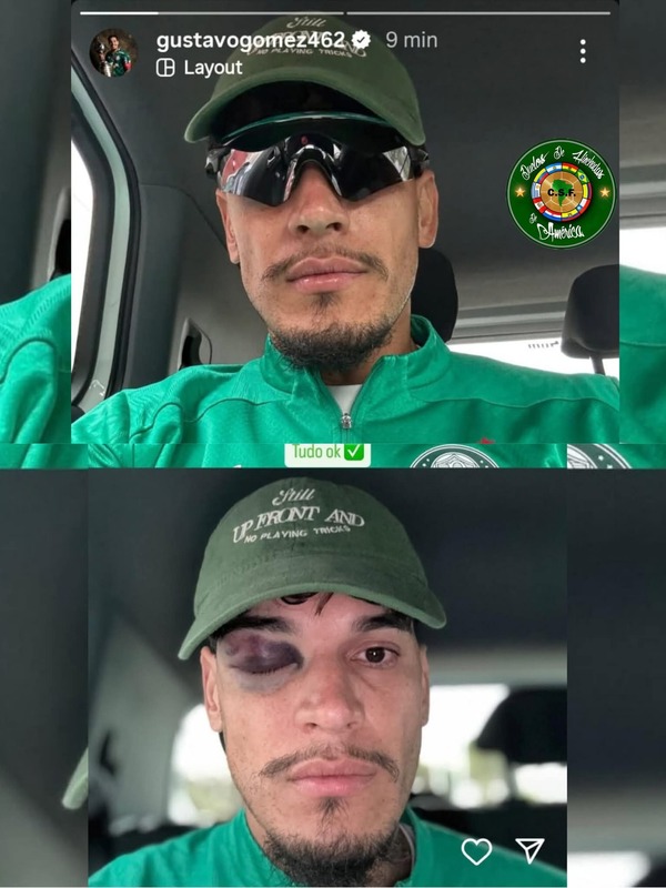 Popular / ¡Ndi bárbaro! El pelotero guaraní Gustavo Gómez mostró como le quedó el ojo anga