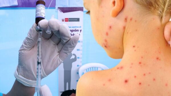 Confirman primer caso de sarampión en Central: ya suman 44 afectados en el país