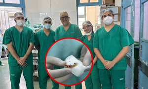 Médicos extraen cinco dientes del pulmón de un paciente en el Ineram - OviedoPress
